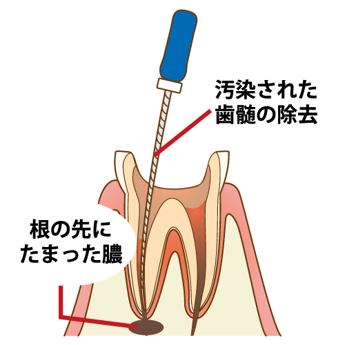 根っこの治療について