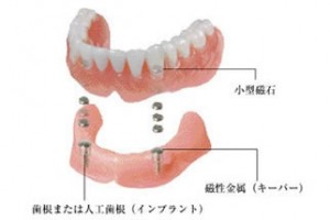 金属床デンチャー