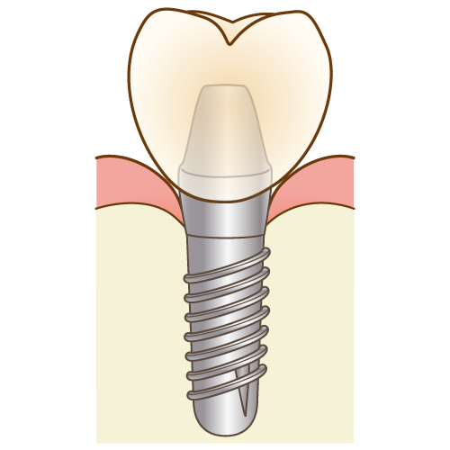 インプラントはとても素晴らしい治療法です。 ぜひ、安心・安全にやってくれる病院でやってください。