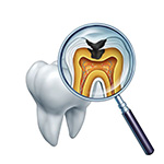 虫歯治療・精密根管治療