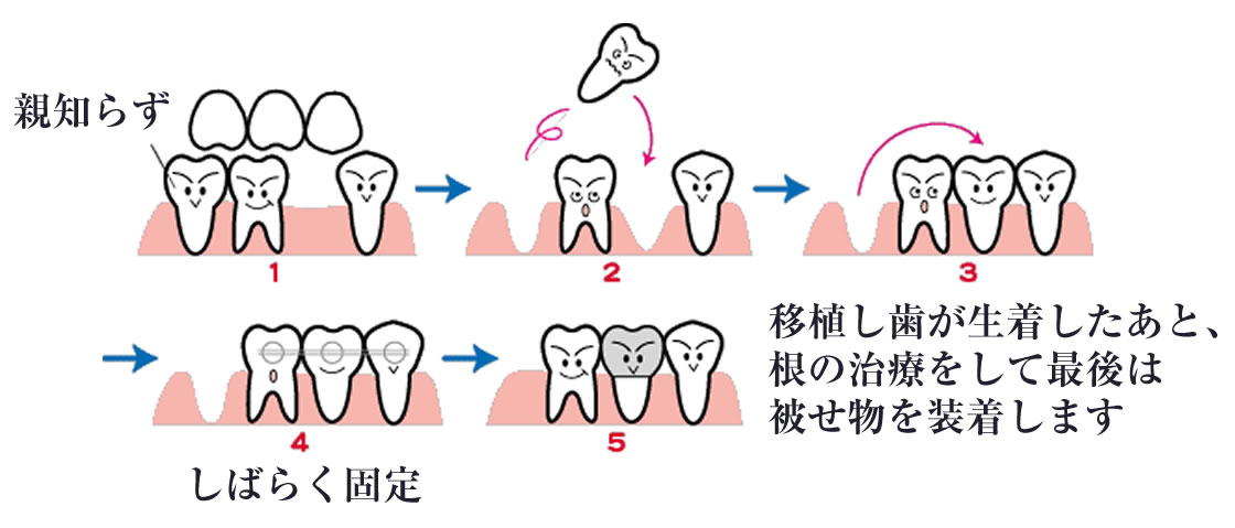 自牙歯牙移植