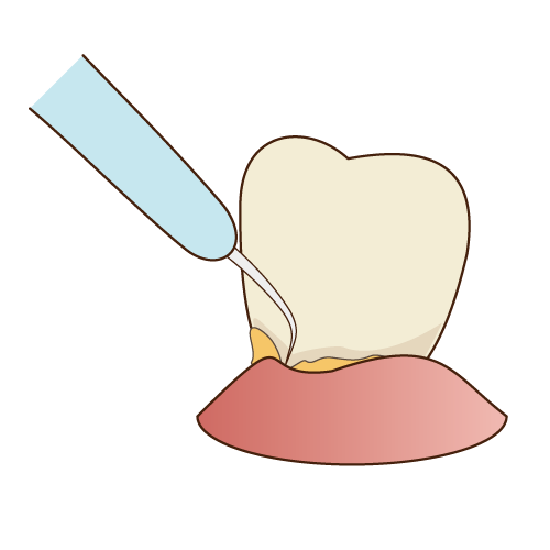 歯医者で行うクリーニングとは？